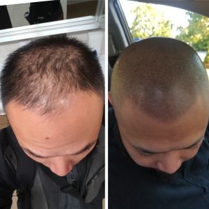 The Journey from Balding to Confidence: How SMP Helped Me