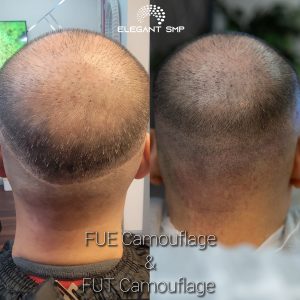 FUE & FUT scars camouflaged with scalp micropigmentation