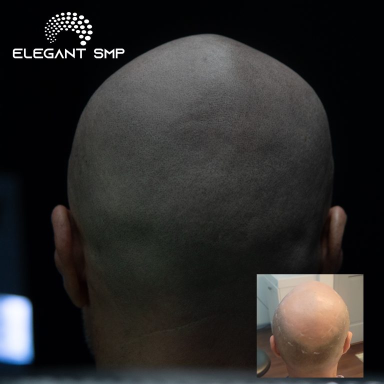 Completely healed scalp micropigmentation results in Buffalo, NY